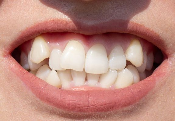 Dientes apiñados solución con Invisalign Apiñamiento Dental
