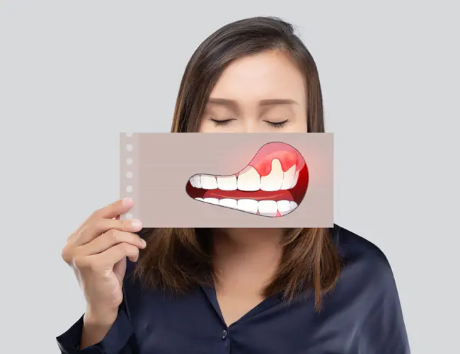 Gingivitis ¿Qué es y cómo curarla?